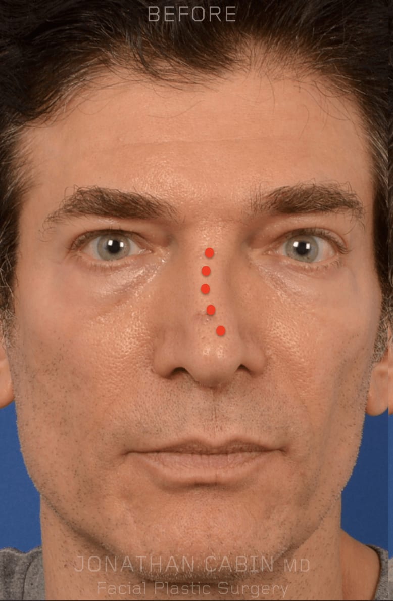 Rhinoplasty Before, Male 50 - 164