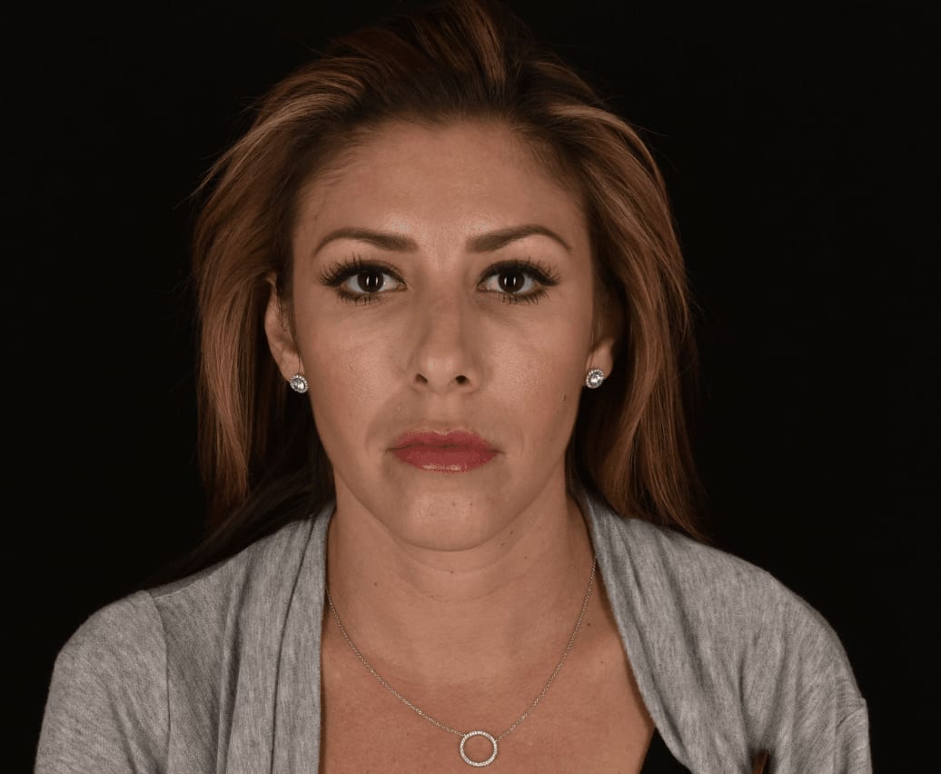 Rhinoplasty Before, Female 33 - 195