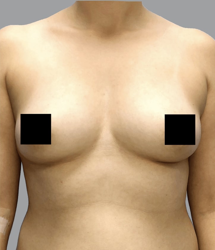 Breast Augmentation with Implants Before, Female 27 - 214