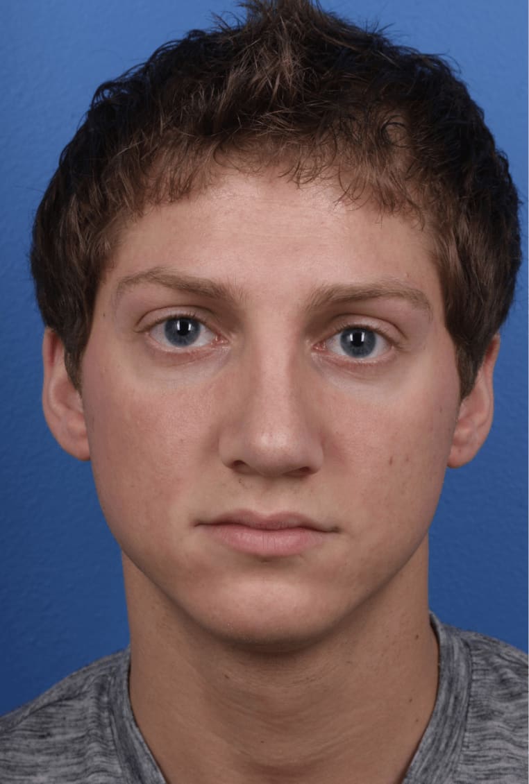 Revision Rhinoplasty After, Male 25 - 216