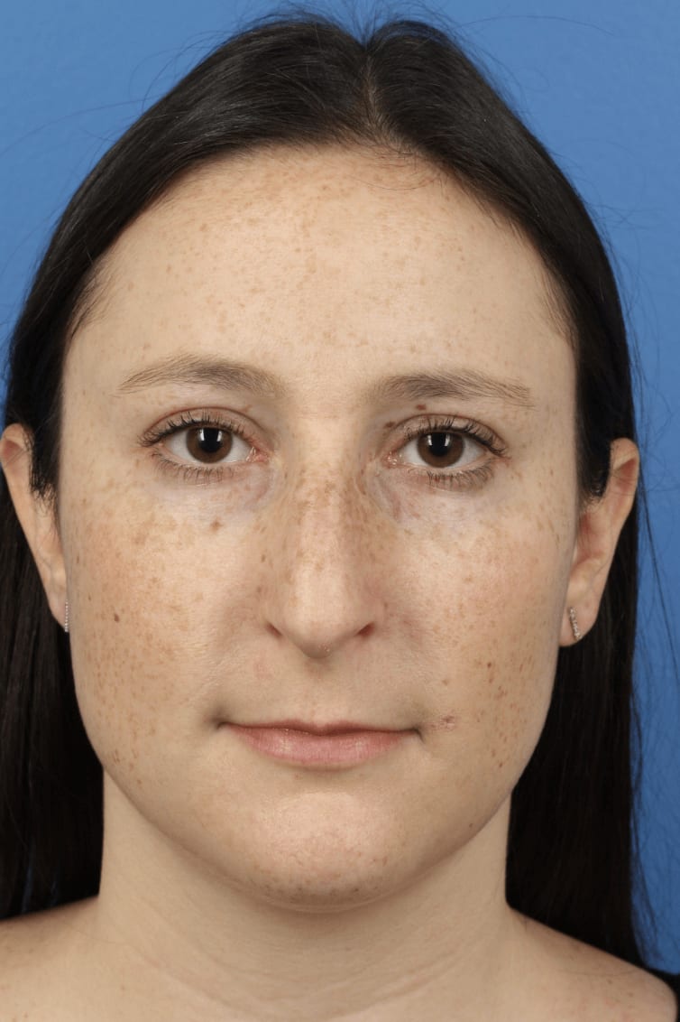 Rhinoplasty Before, Female 32 - 219