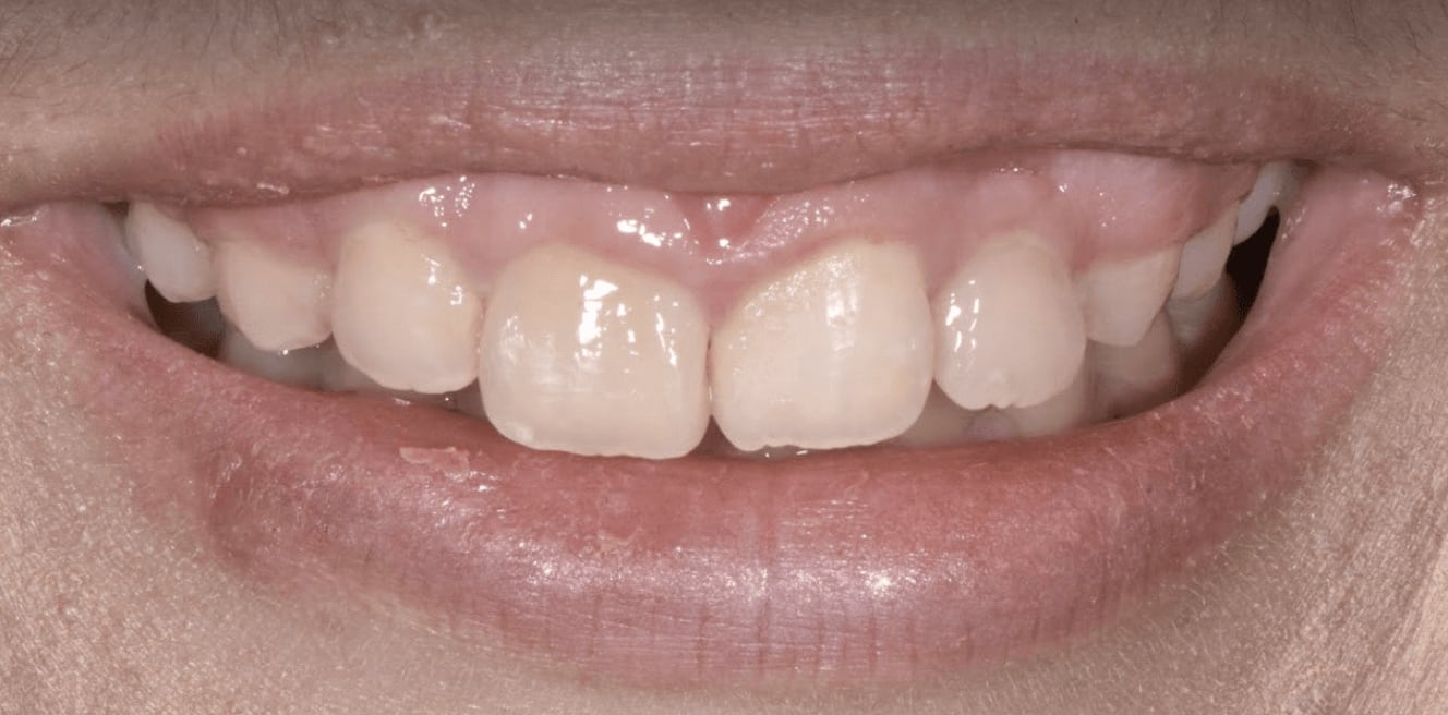 Dental Veneers Before, Female 24 - 227