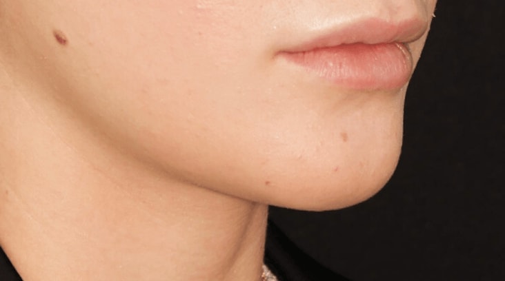 Lip Augmentation and Injections Before, Female 24 - 237