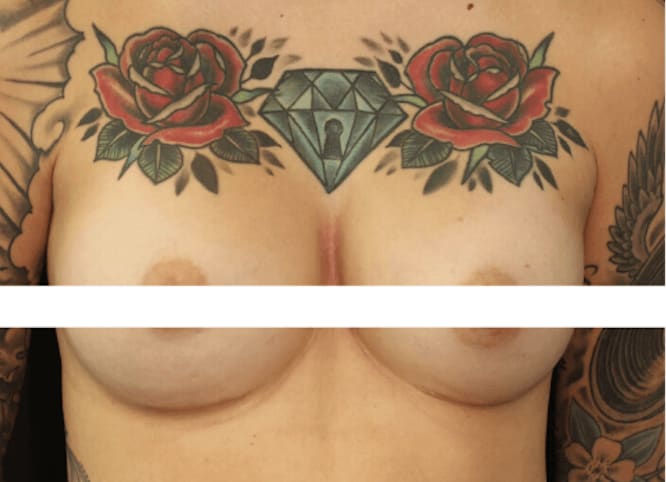 Breast Augmentation with Implants After, Female 32 - 244
