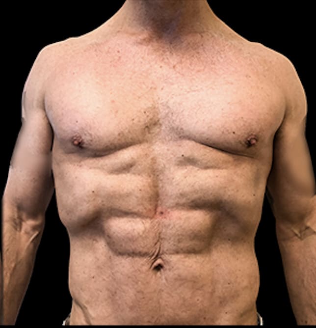 Liposculpture After, Male 56 - 303