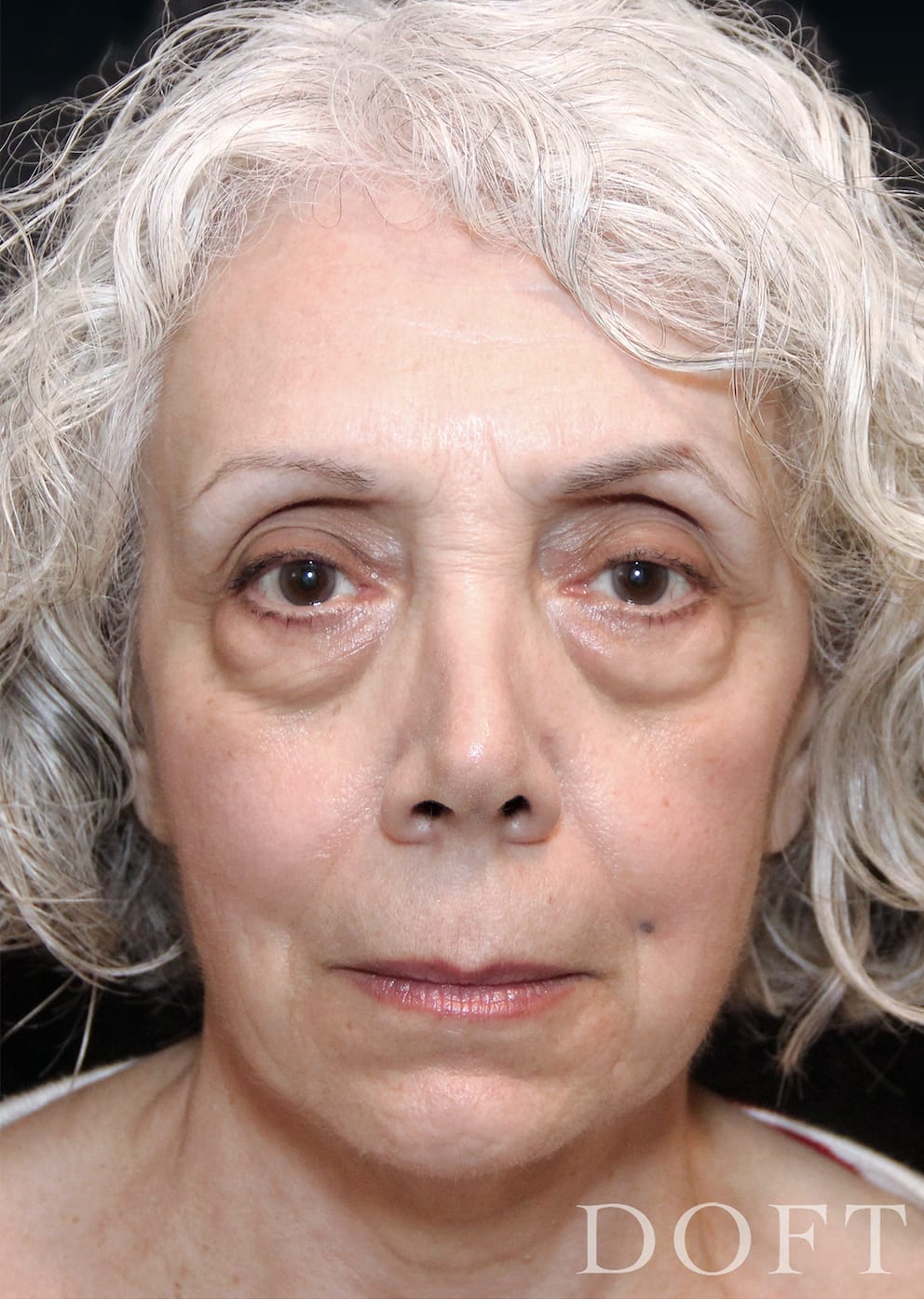 Blepharoplasty Before, Female 59 - 273