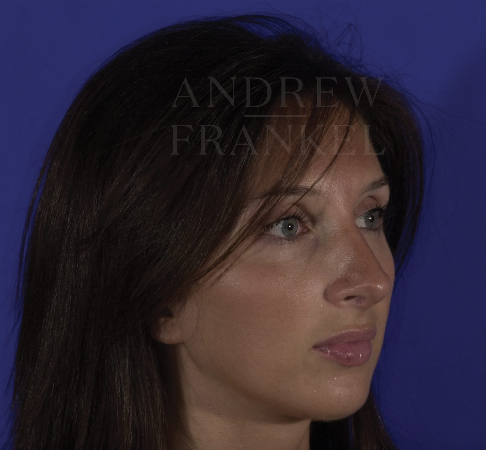 Revision Rhinoplasty After, Female 23 - 313