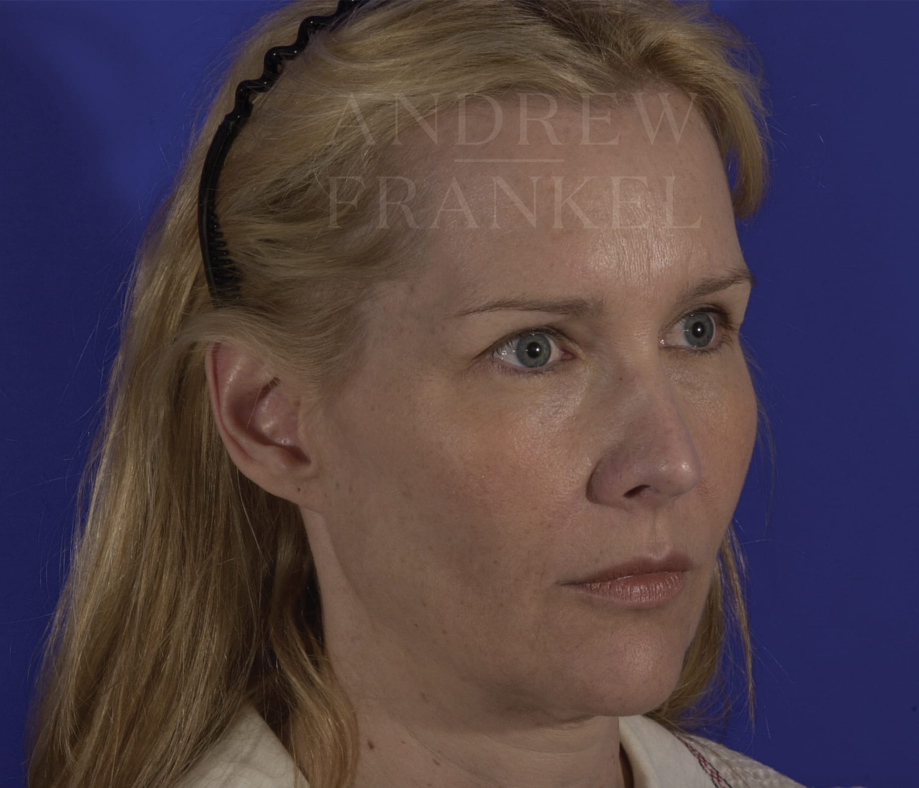 Deep Plane Facelift Before, Female 52 - 314