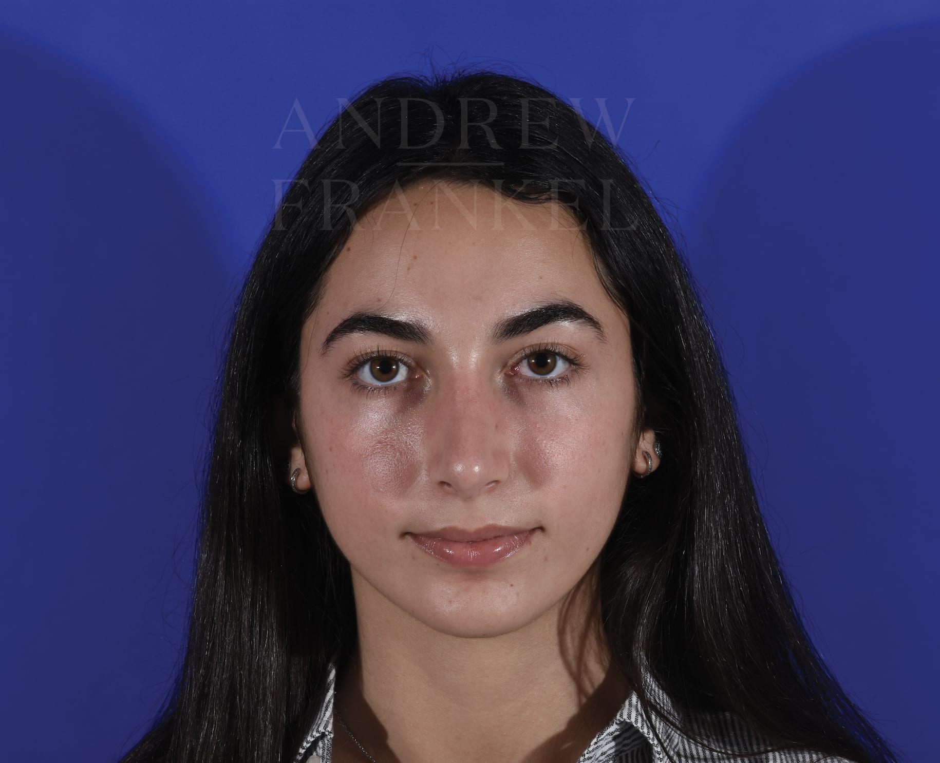 Rhinoplasty After, Female 19 - 316