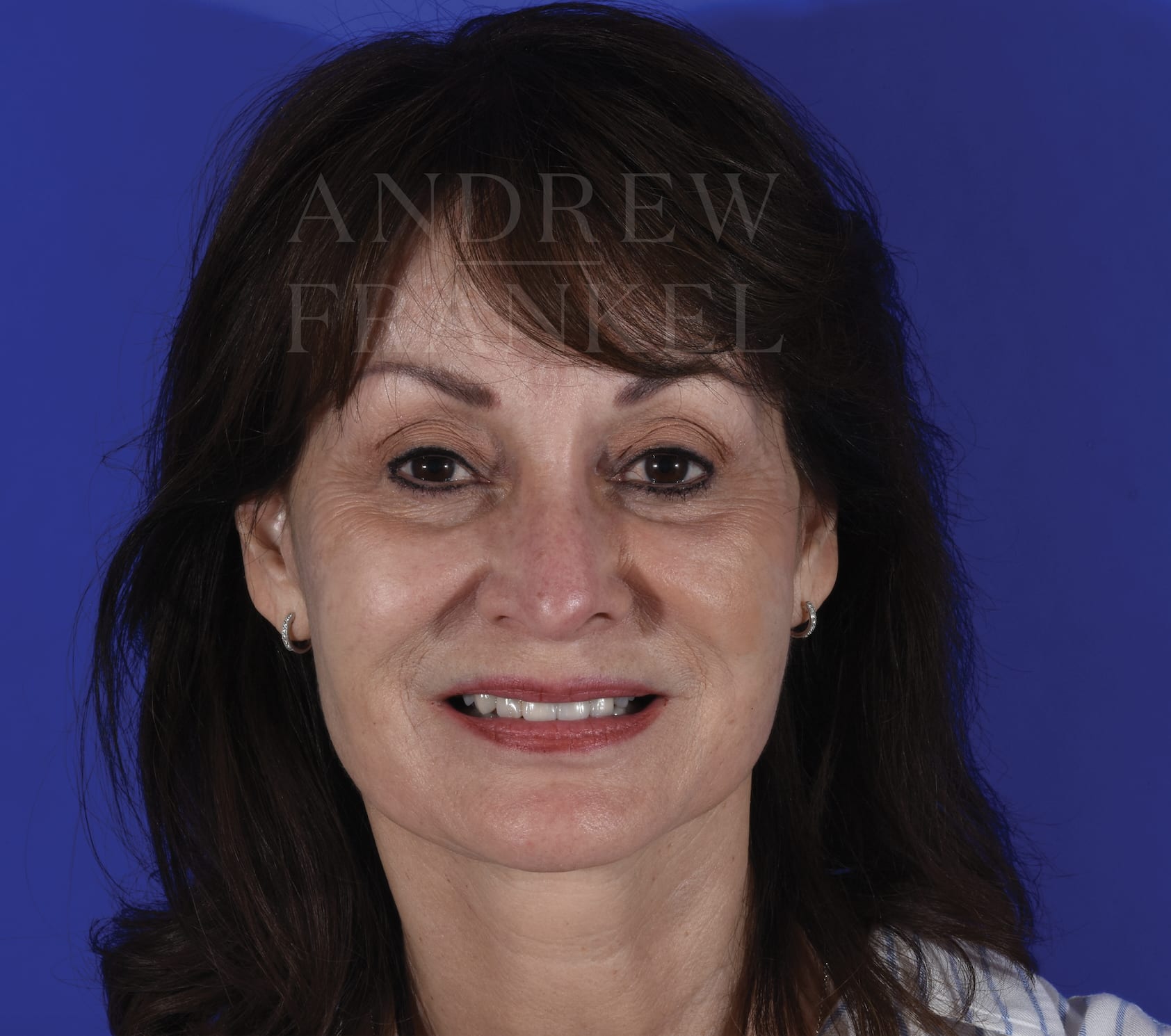 Deep Plane Facelift After, Female 70 - 318