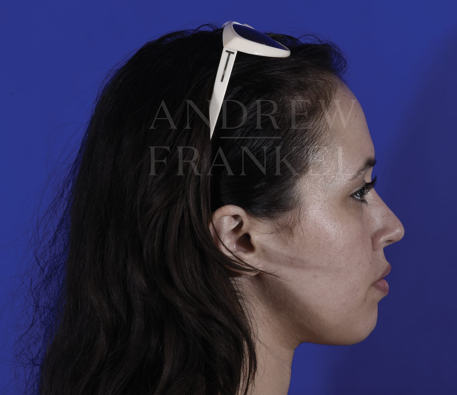 Liposuction After, Female 26 - 319