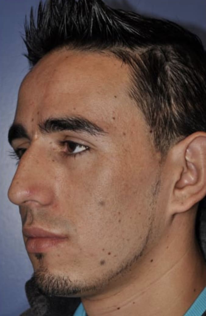 Rhinoplasty Before, Male 27 - 325