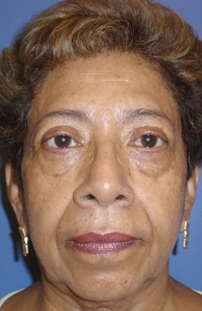 Facelift Before, Female 68 - 327