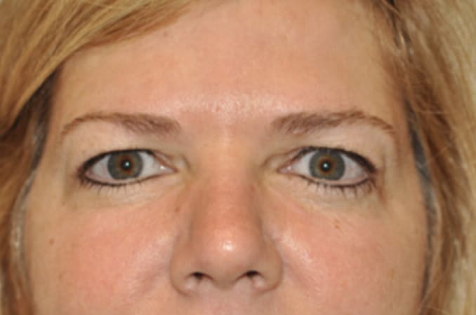 Blepharoplasty Before, Female 43 - 329