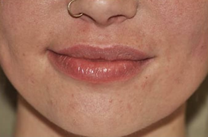 Lip Augmentation and Injections Before, Female 24 - 332
