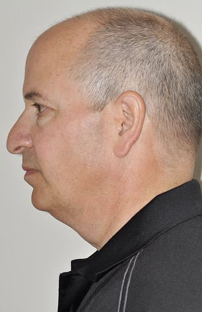 Neck Lift Before, Female 61 - 333