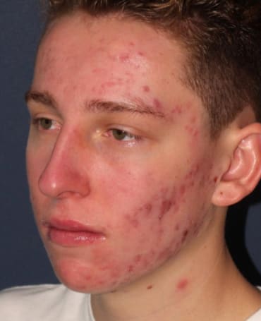 Acne Treatment Before, Male 18 - 339