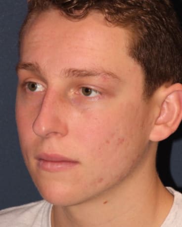 Acne Treatment After, Male 18 - 339