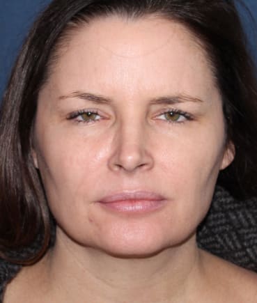 Botox After, Female 40 - 340