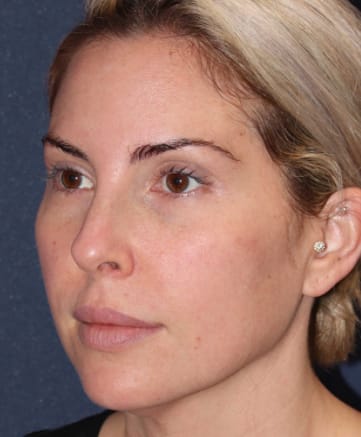 Dermal Fillers & Injectables After, Female 35 - 342