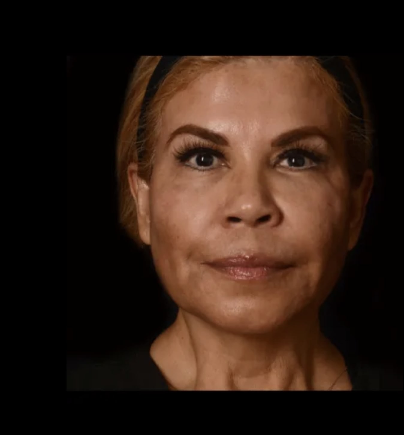 Liquid Facelift Before, Female 46 - 378