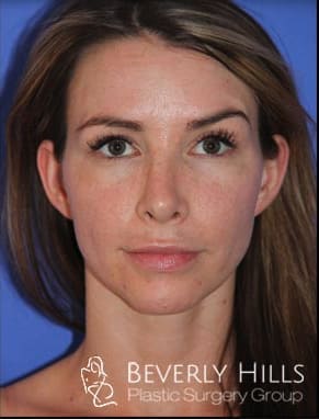 Revision Rhinoplasty After, Female 31 - 414