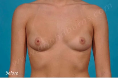 Breast Augmentation (Augmentation Mammaplasty) Before, Female 28 - 483