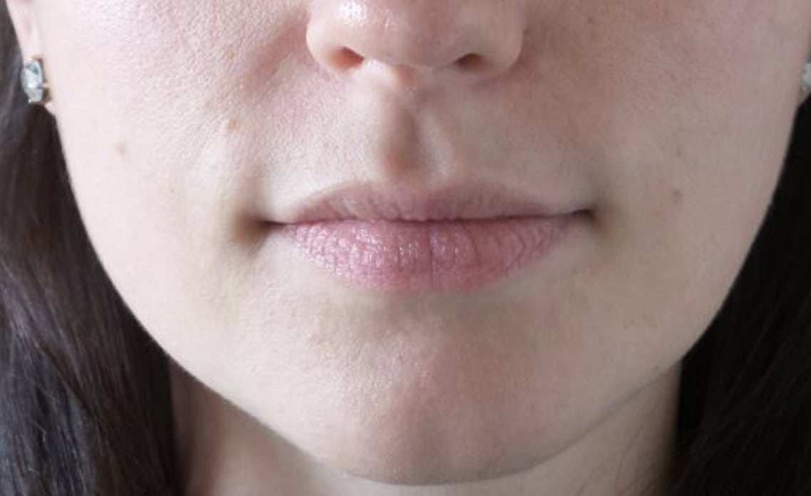 Lip Lift Before, Female 33 - 515