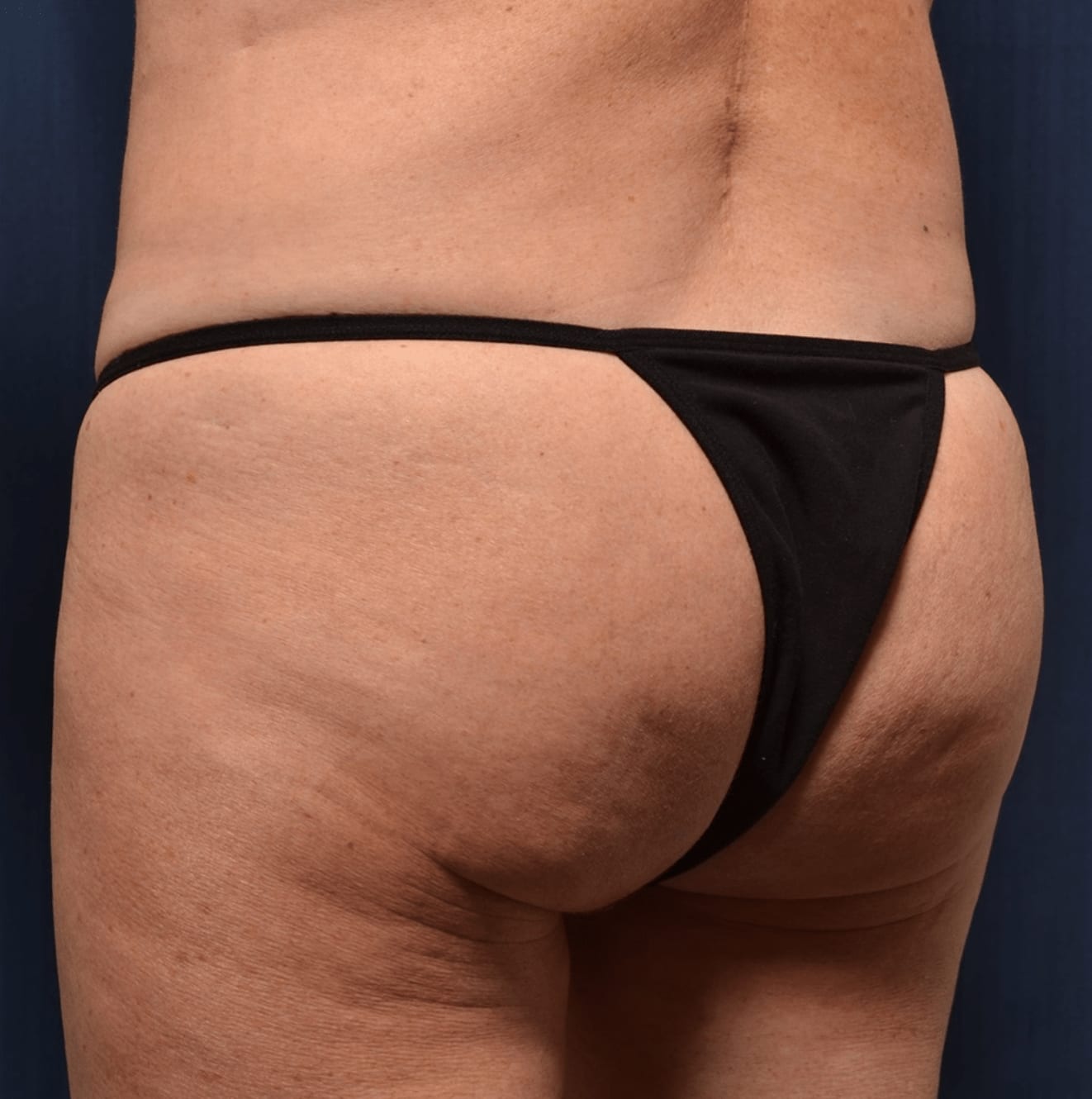 Butt Lift Before, Female 44 - 542