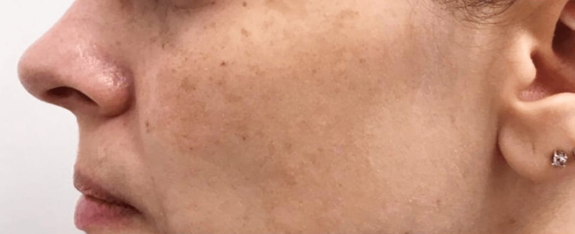 Fraxel® Repair Before, Female 32 - 564