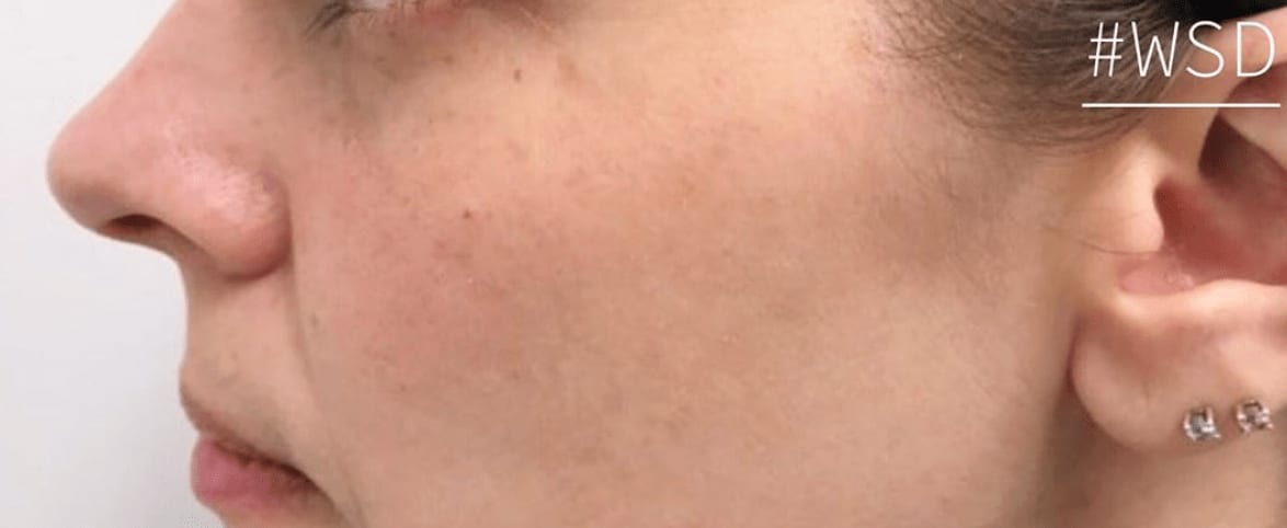 Fraxel® Repair After, Female 32 - 564