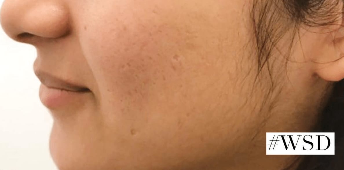 Acne Treatment After, Female 27 - 555