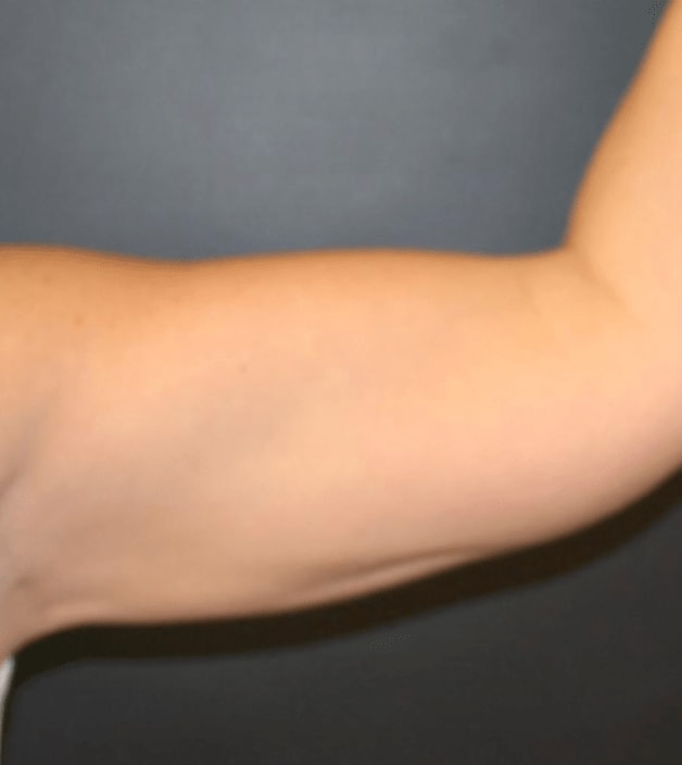 Arm Lift After, Female 32 - 568