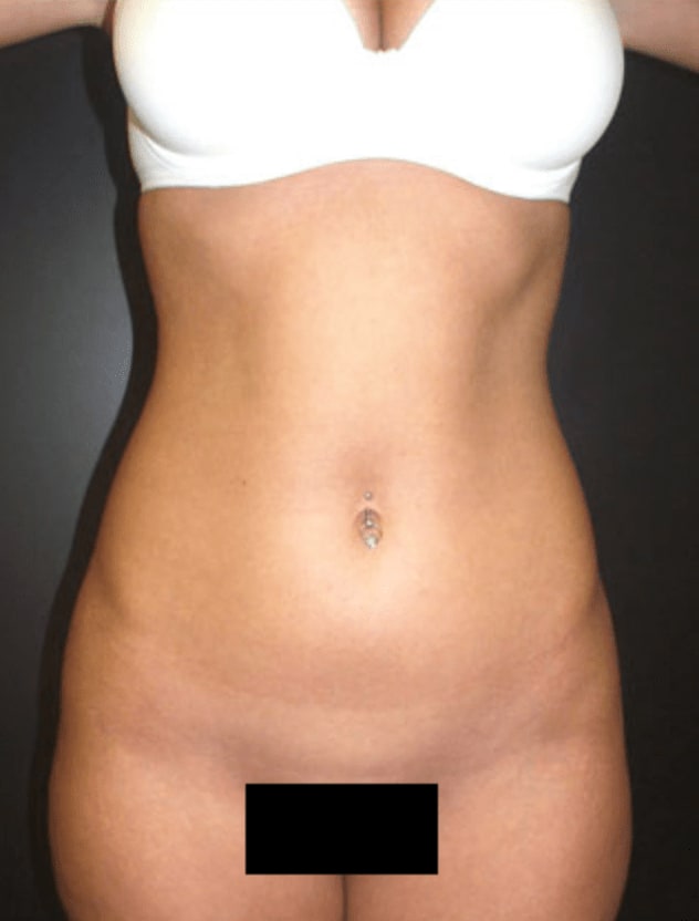 Liposuction After, Female 27 - 573