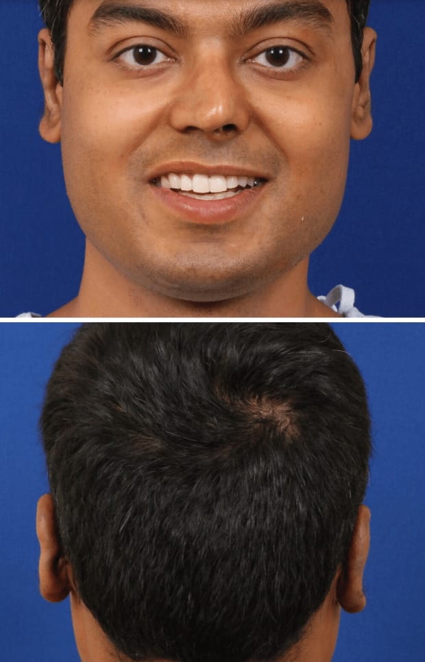 Earlobe Surgery After, Male 28 - 590