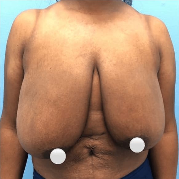 Breast Reduction Before, Female 35 - 604