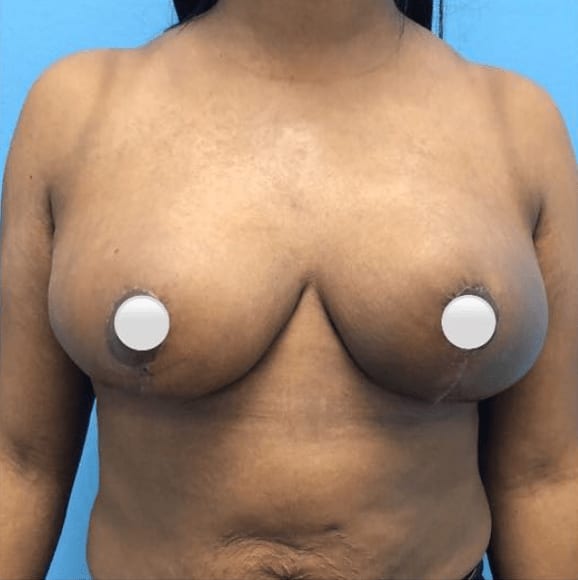 Breast Reduction After, Female 35 - 604