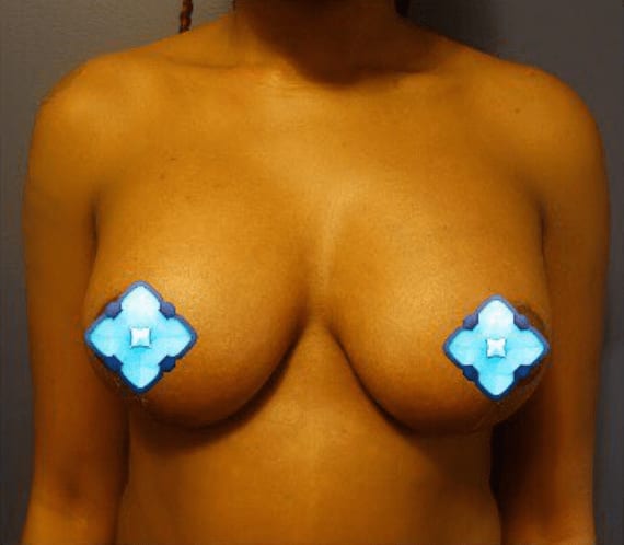 Breast Lift After, Female 34 - 605