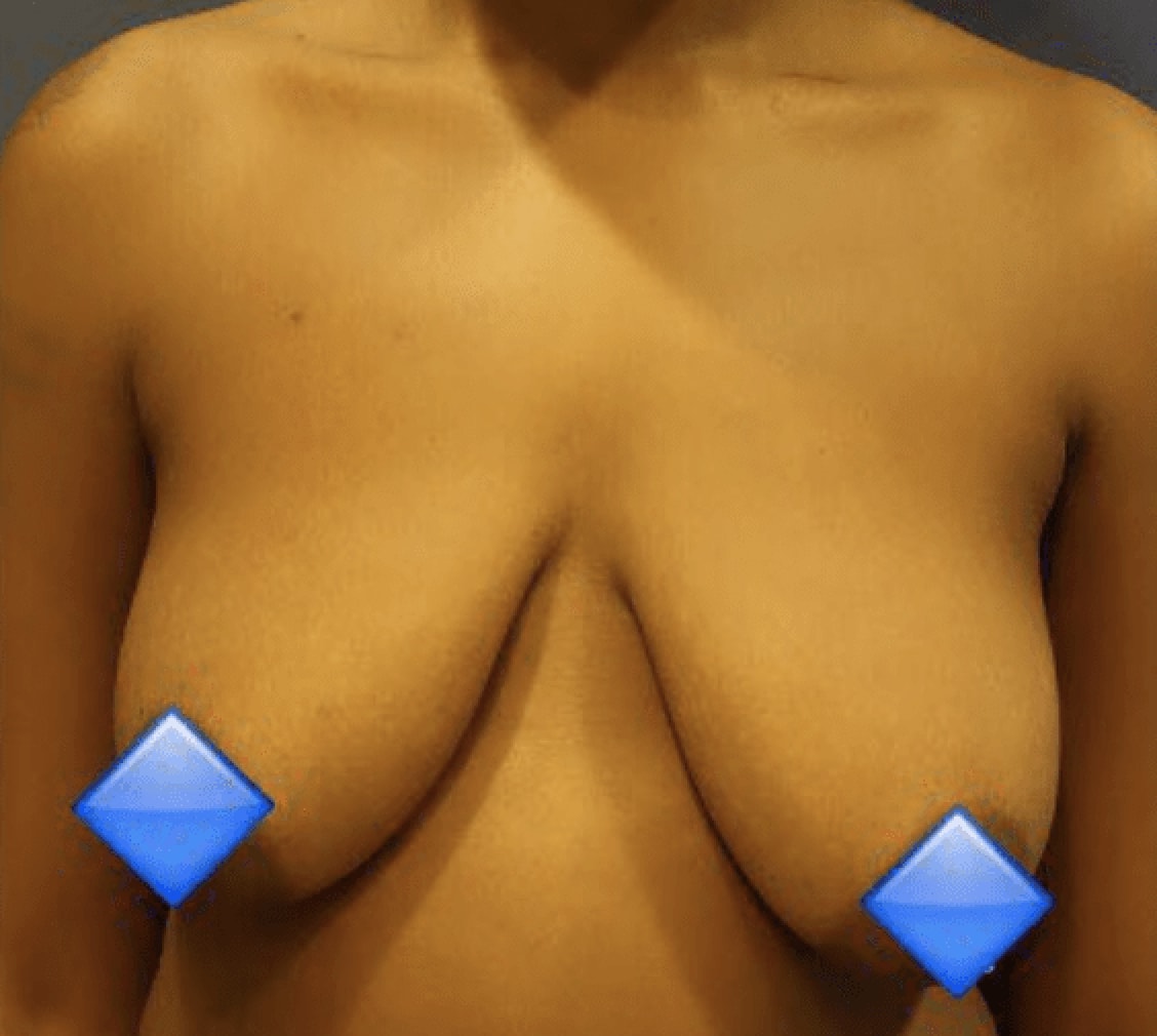 Breast Lift Before, Female 34 - 605