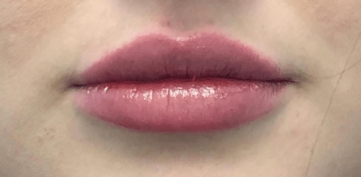 Lip Augmentation and Injections After, Female 25 - 610