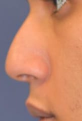 Rhinoplasty Before, Male 21 - 618