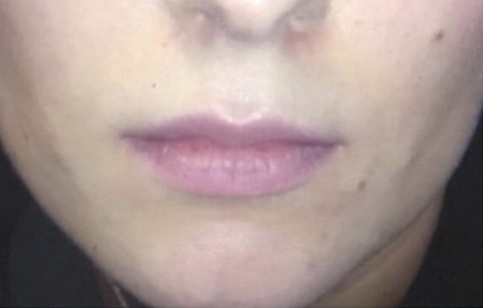 Lip Augmentation and Injections Before, Female 32 - 633