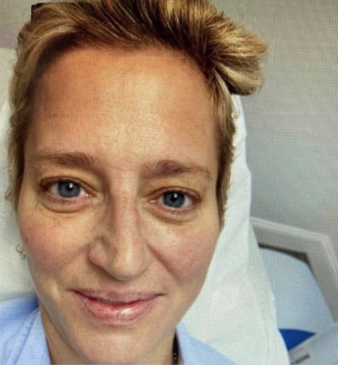 Fraxel® Repair Before, Female 35 - 631