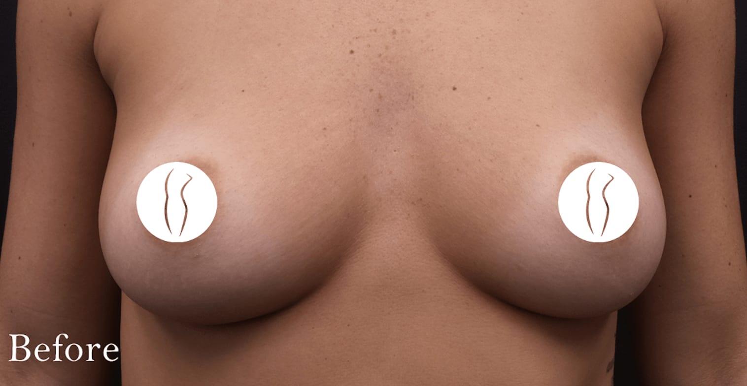Breast Augmentation with Implants Before, Female 24 - 707