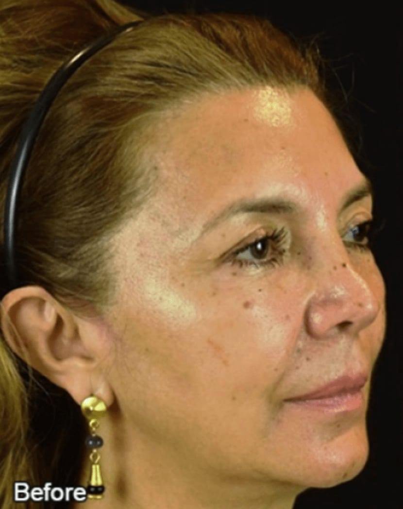 PDO Thread Lift Overview Cost, Recovery, Before & After AEDIT