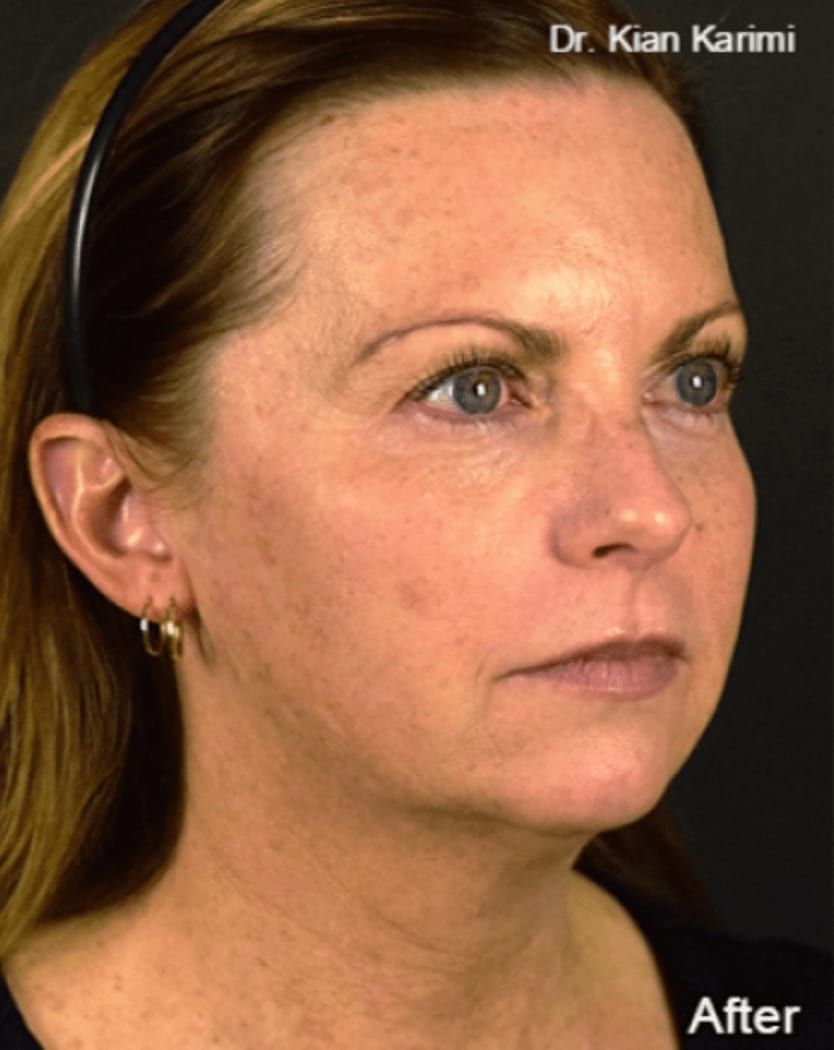 PDO Thread Lift Overview Cost, Recovery, Before & After AEDIT