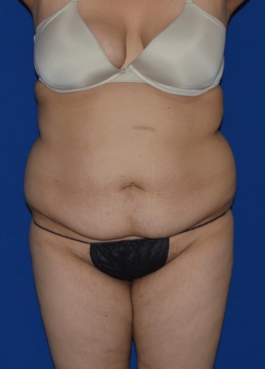 Tummy Tuck (Abdominoplasty) Before, Female 24 - 758