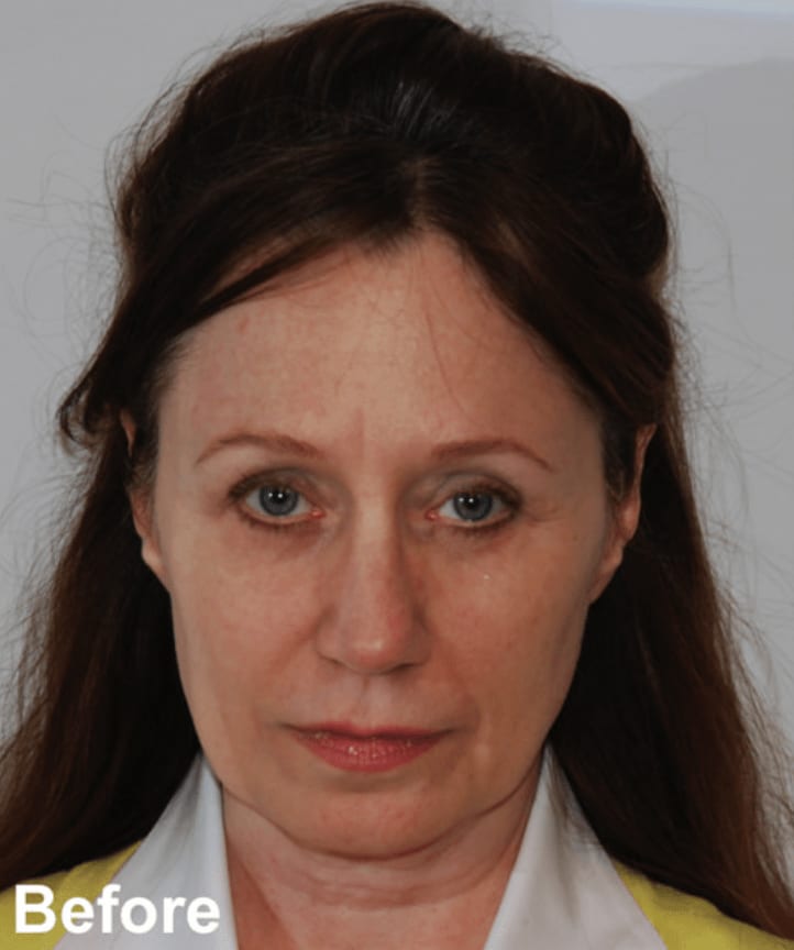 Facelift Before, Female 48 - 796