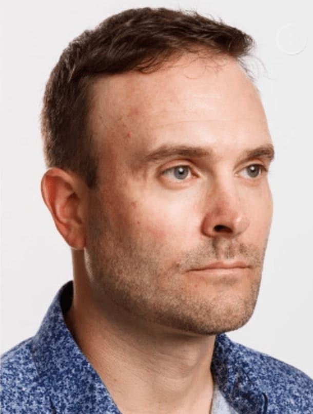 Botox After, Female 76 - 799