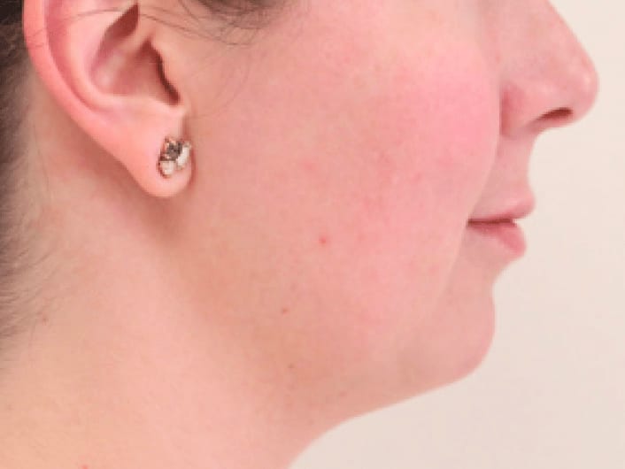 Kybella® Before, Female 35 - 832